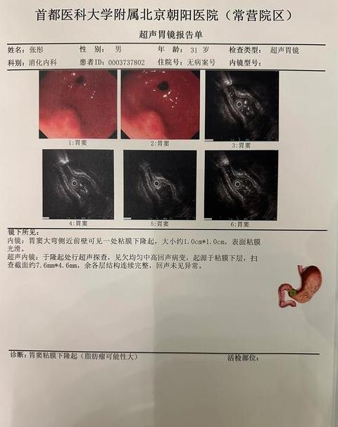 胃间质瘤术后饮食指南及辅助药物推荐