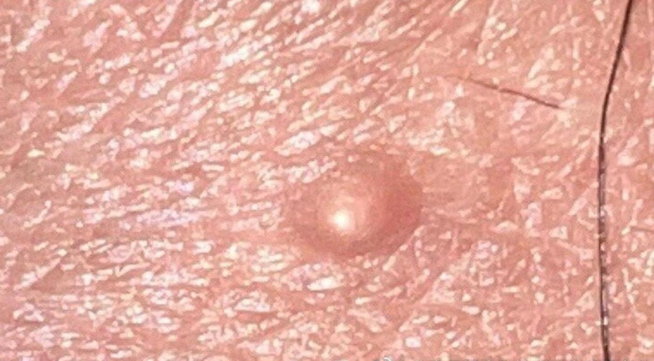 蛋蛋痘痘用药膏，感受火辣还是温和？