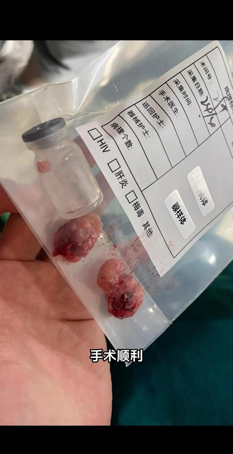 儿童腺样体肥大手术：切除还是保守治疗？费用一览